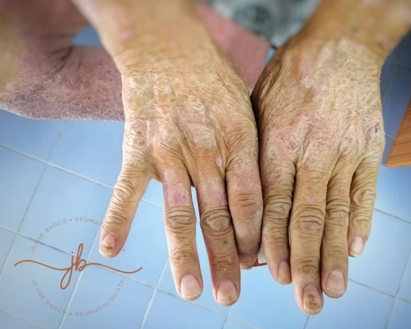 Doença autoimune tem cura?